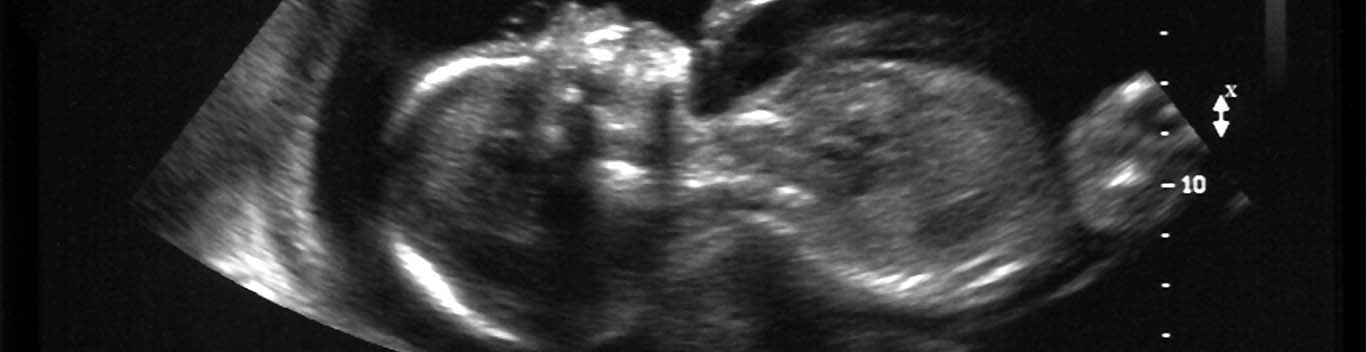20 weeks pregnant ultrasound abnormalities