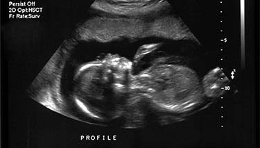 7 Week - Pregnancy Scan - AU