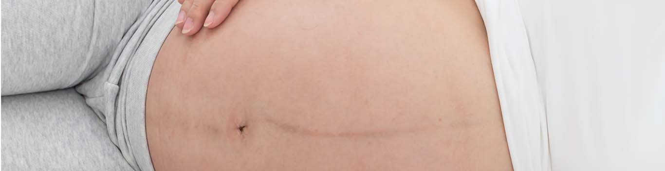 Black line on tummy during shop pregnancy and gender of fetus